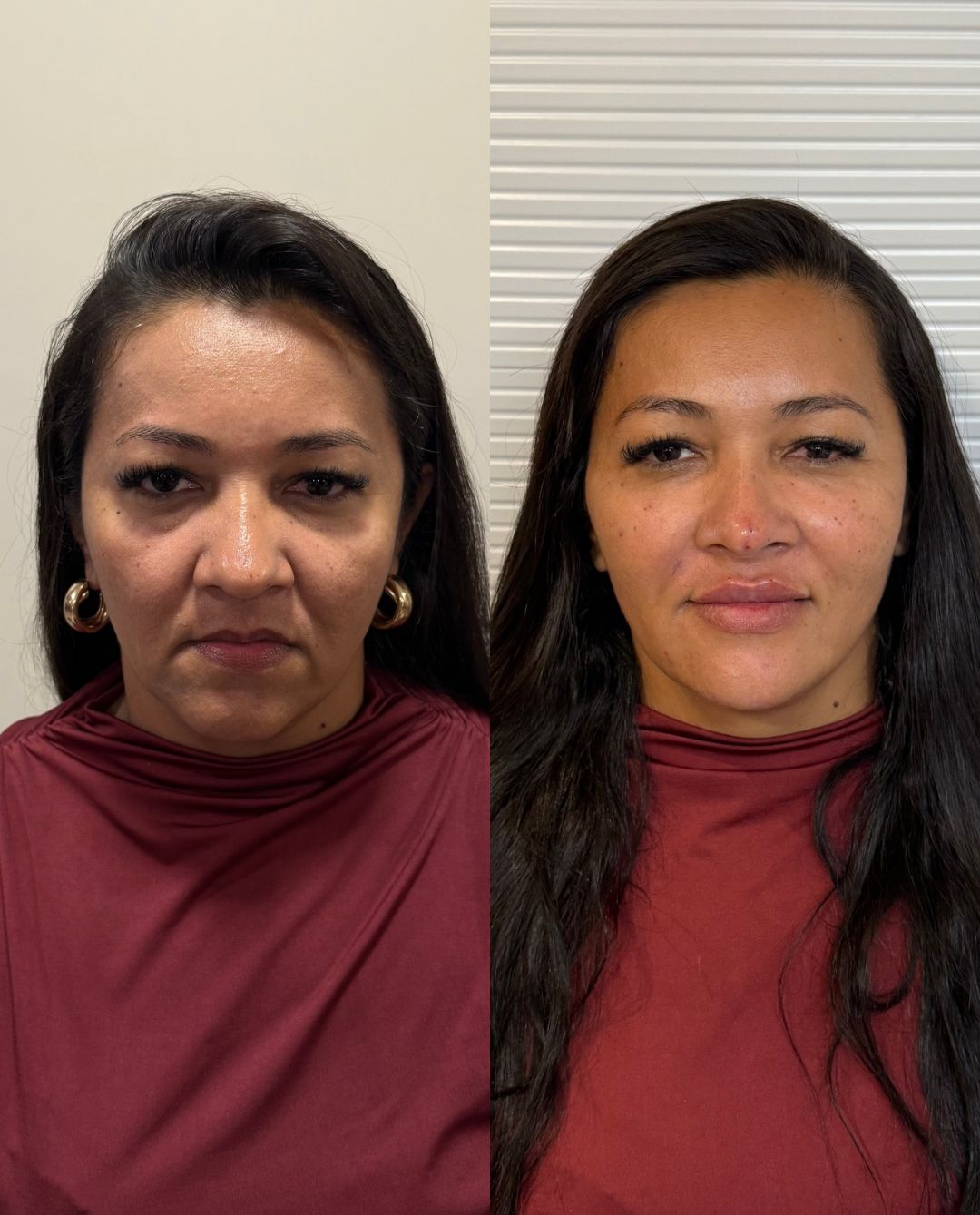 Antes e depois — contorno facial