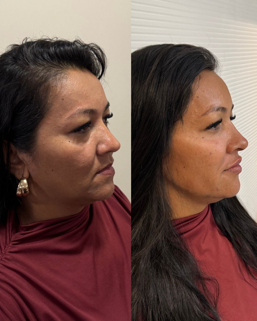 Antes e depois — perfil