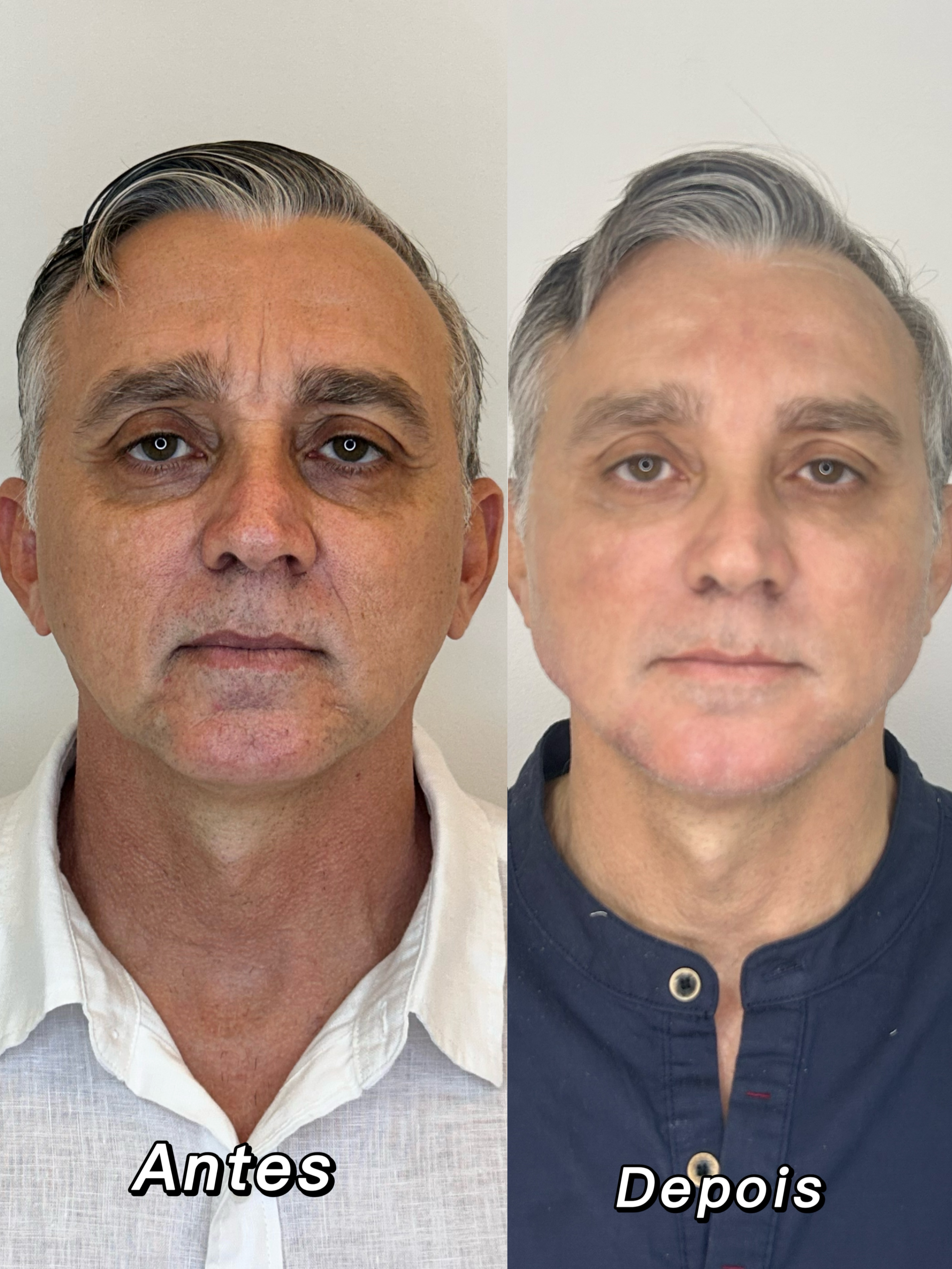 Antes e depois — rejuvenescimento masculino