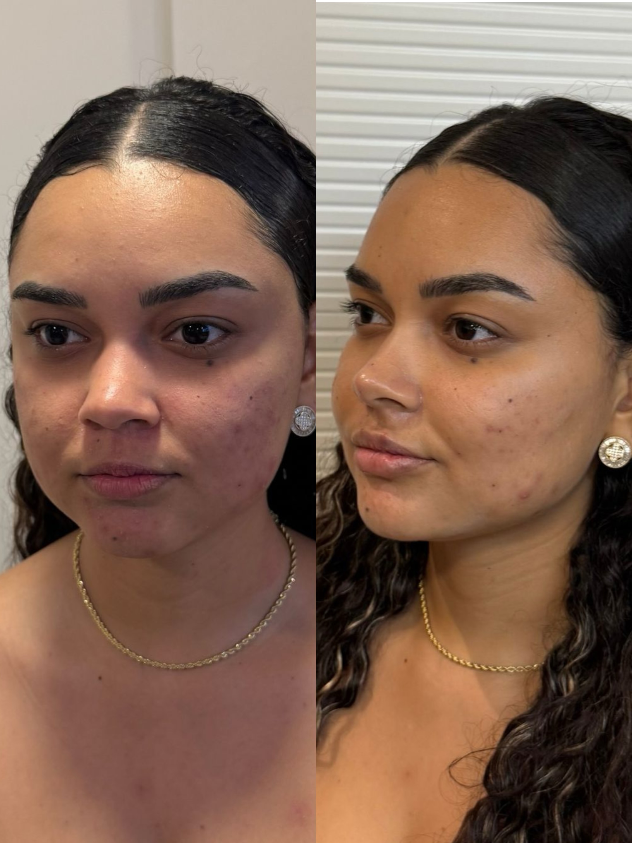 Antes e depois — saúde da pele