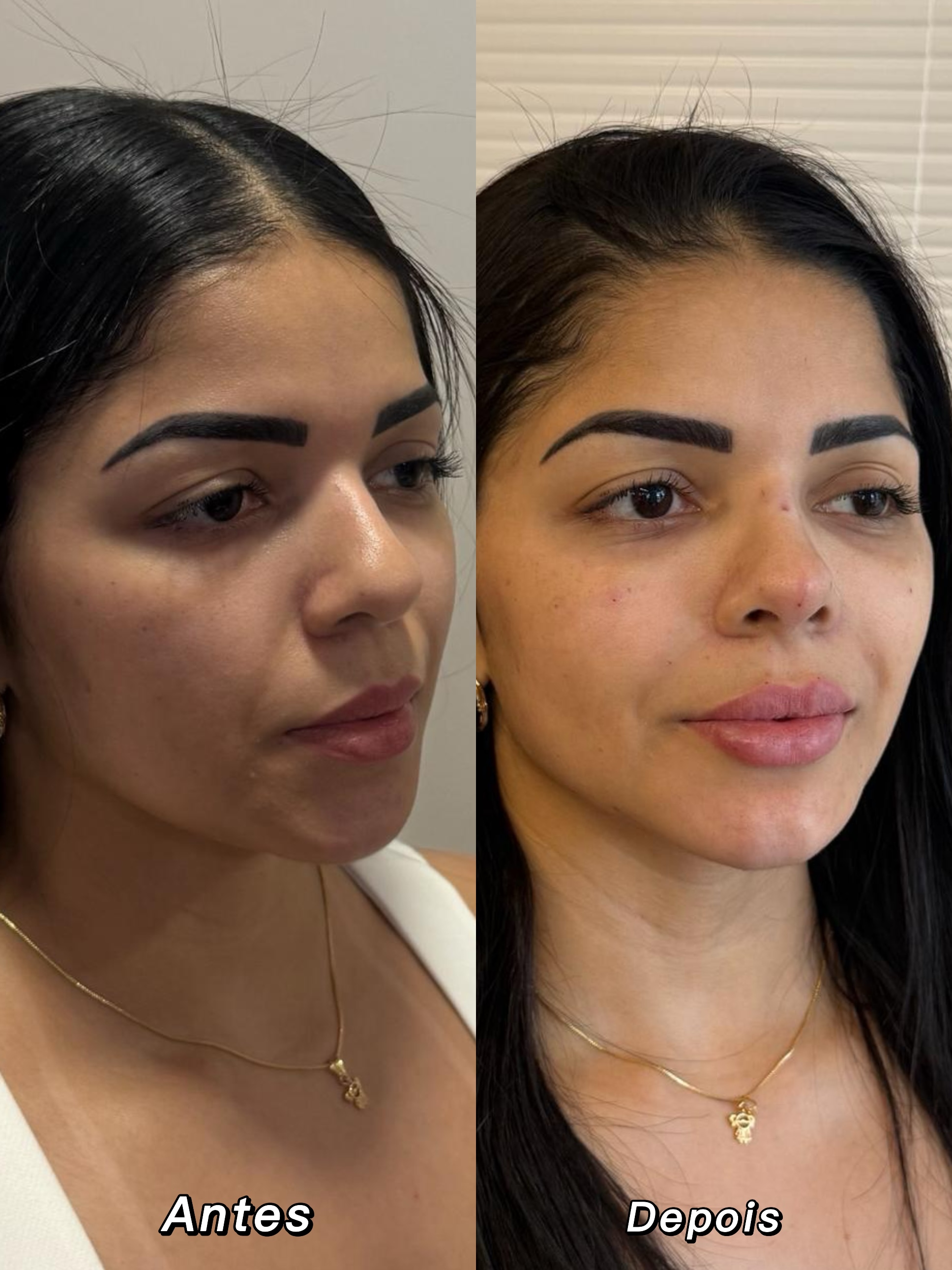 Antes e depois — olheiras e contorno