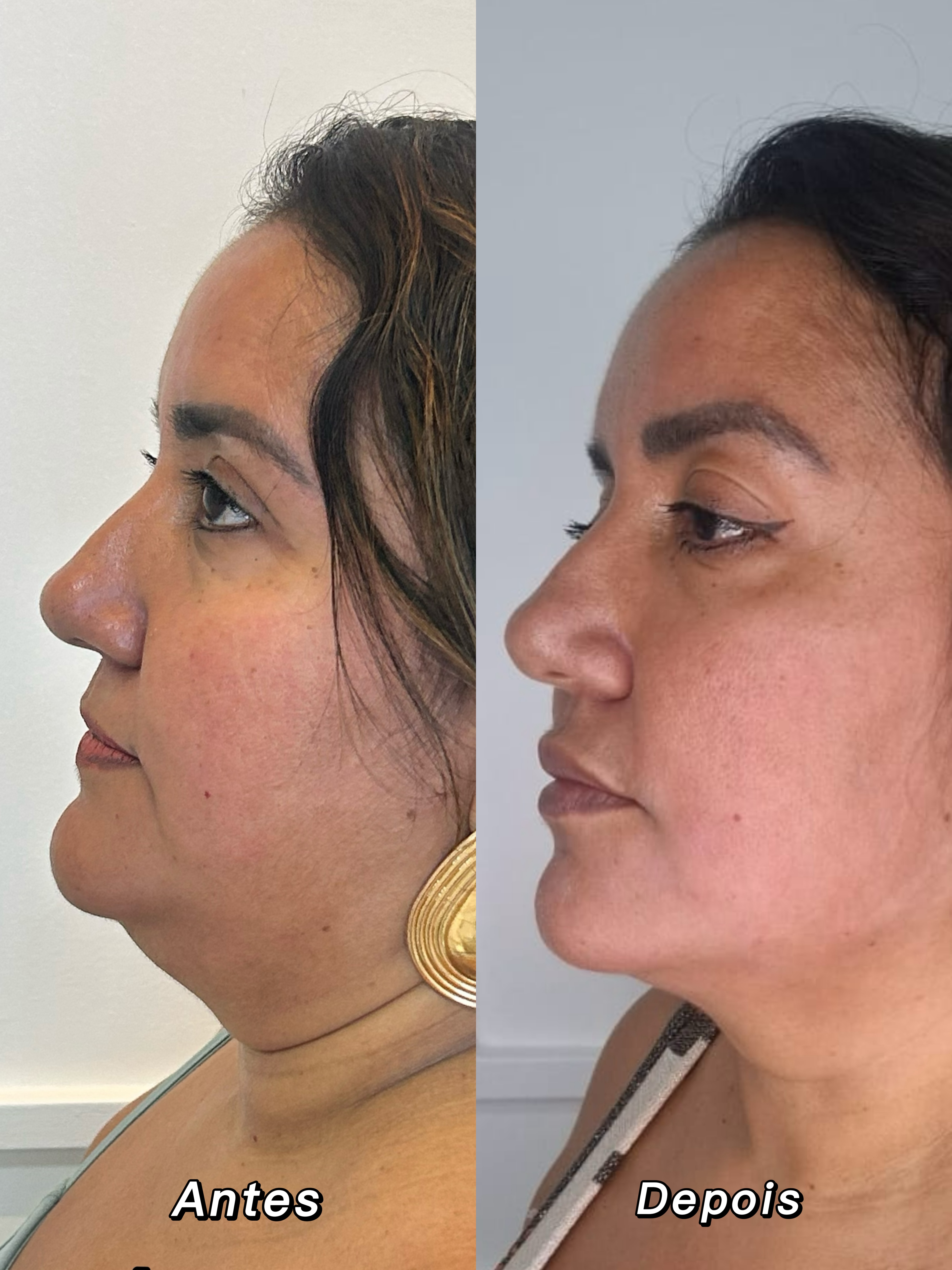 Antes e depois — perfil e mandíbula