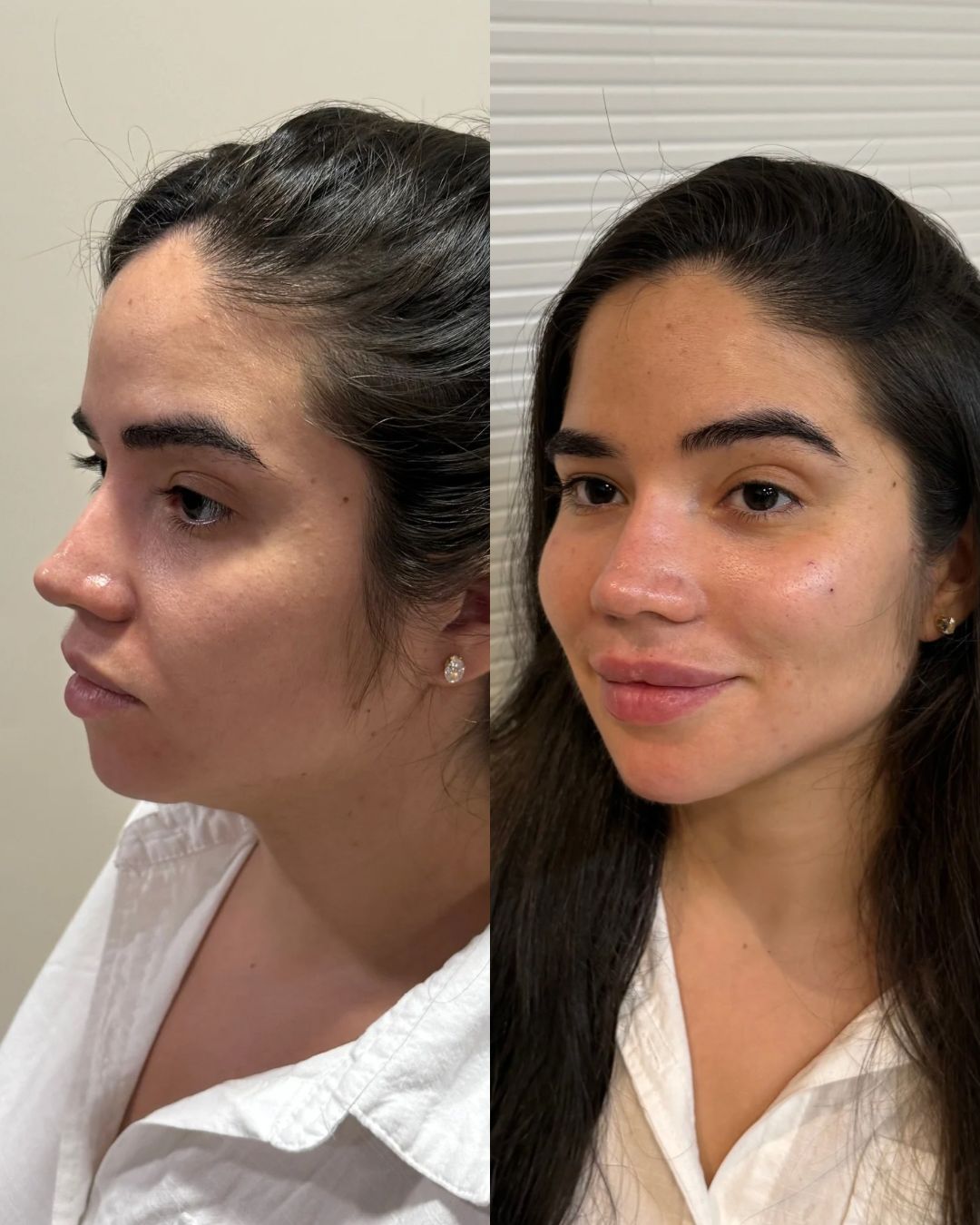 Antes e depois — perfil e lábios